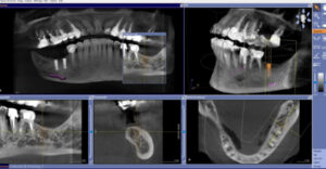 La couronne sur implant