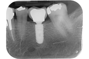 La couronne sur implant